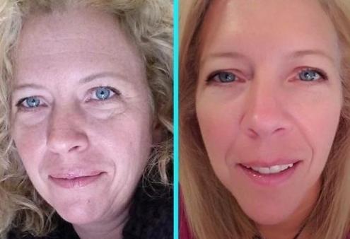 Facelift Without Surgery